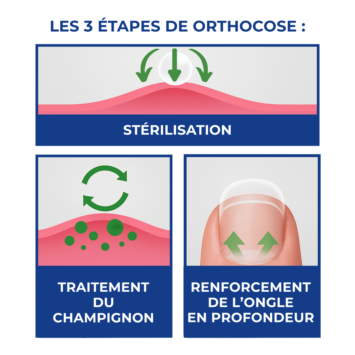 OrthoCose™ | Appareil anti-mycoses