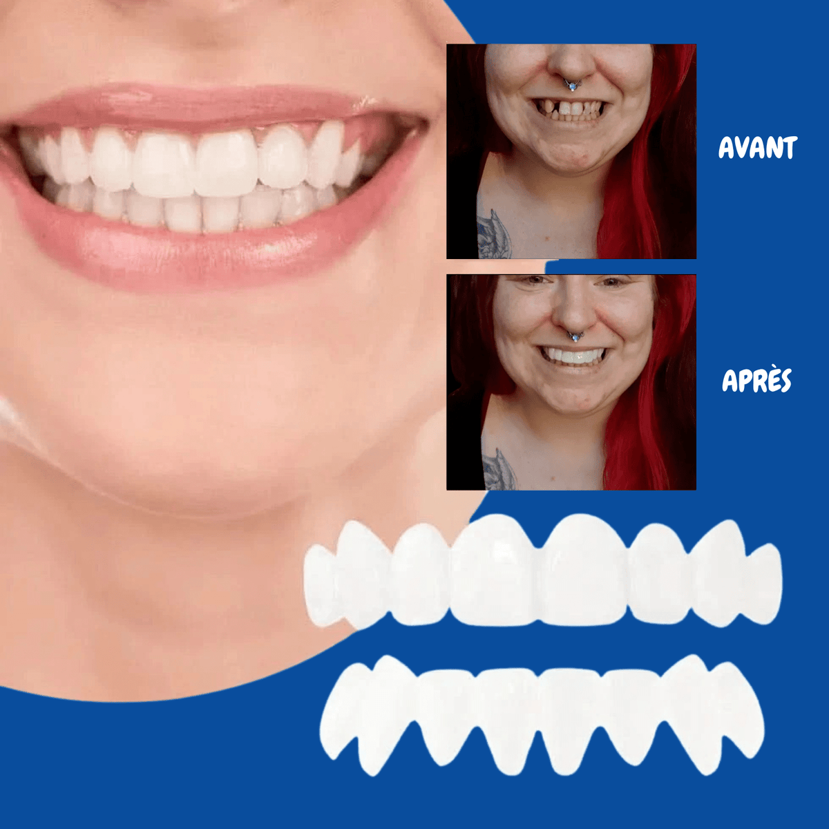 DentalFlex™ | Set de facettes modulables (haut et bas)