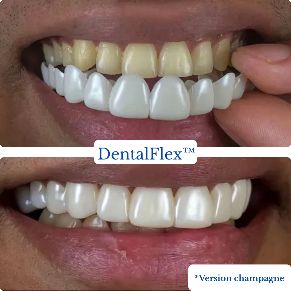DentalFlex™ | Set de facettes modulables (haut et bas)
