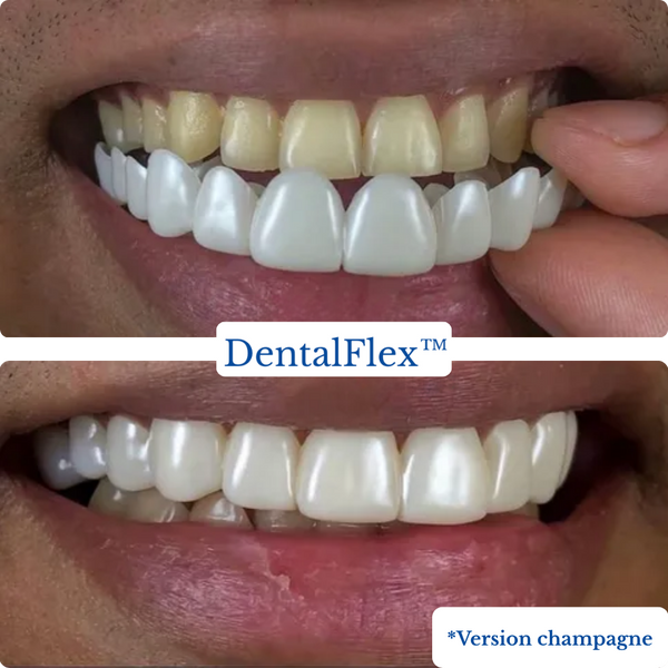 DentalFlex™ | Set de facettes modulables (haut et bas)