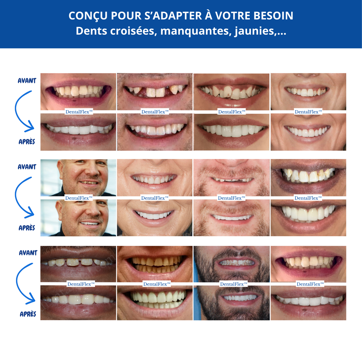 DentalFlex™ | Set de facettes modulables (haut et bas)