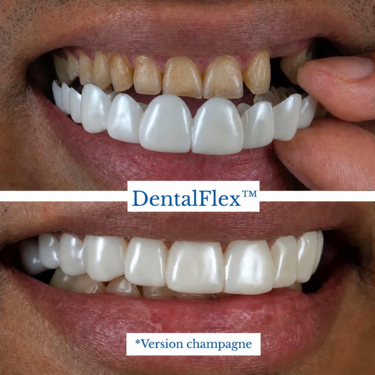 DentalFlex™ | Set de facettes modulables (haut et bas)